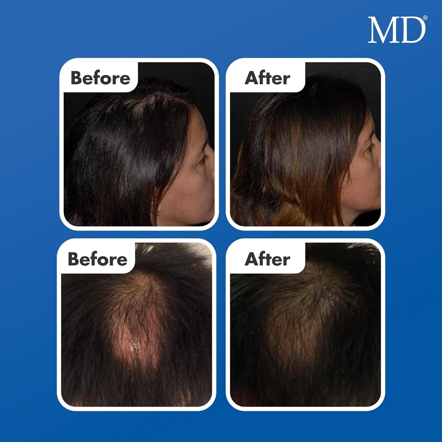 MD suero natural para el crecimiento del cabello | Follicle Energizer Serum: evita el adelgazamiento del cabello y la pérdida de cabello al estimular los folículos capilares para producir un ca