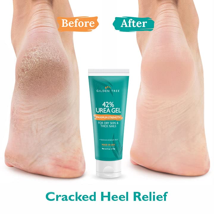 Urea Gel 42 Percent For Feet Maximum Strength Softens Cracked Heel Calluses & Thick Toenails