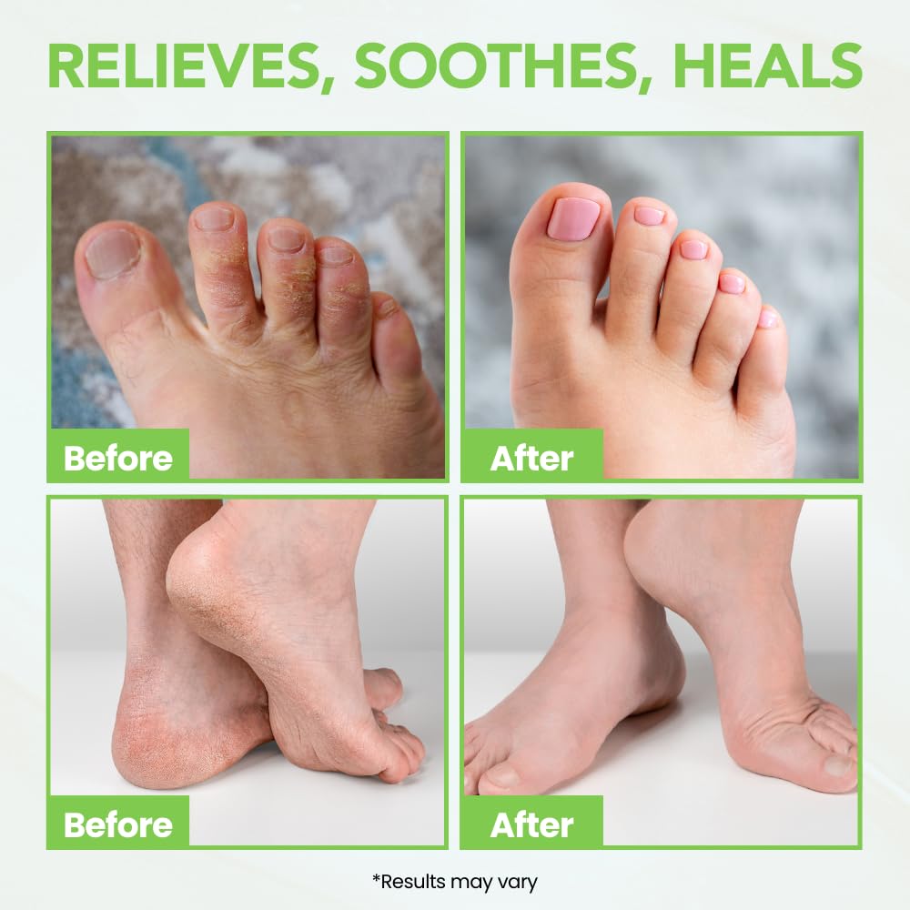 THENA Athlete’s Foot Treatment Balm Extra Strength with Tea Tree Peppermint Neem, Powerful Natural Anti-Itch Foot & Skin Cream Soothes & Relieves Itchy, Dry, Cracked Feet, Heels, Toenails, Jock Itch