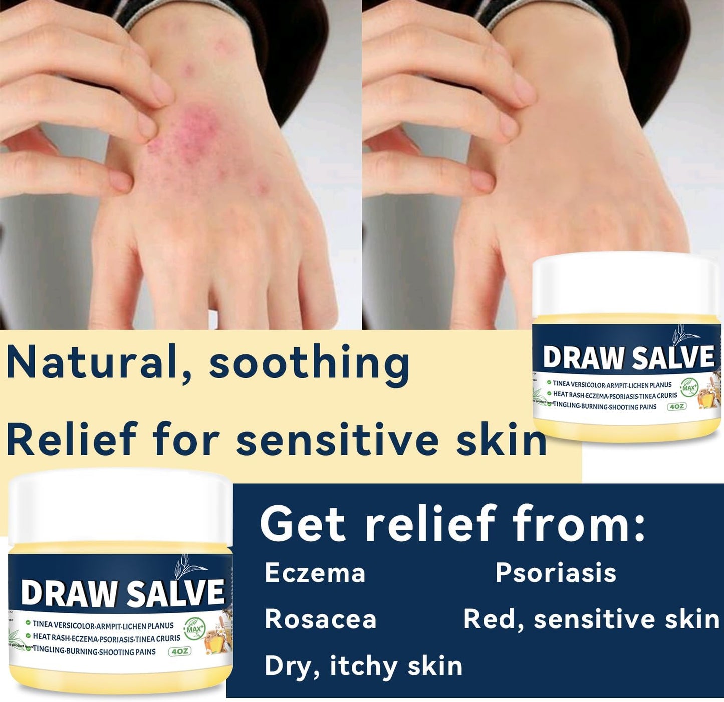 Manuka Honey Tea Tree Cream, Scaling Max Strength Soothing Ointment, Foot Care, Jock Itch, Ringworm, Foot Odour, Dry Cracked Heels, Athlete's Foot Treatment, itching, Burning, Cracking