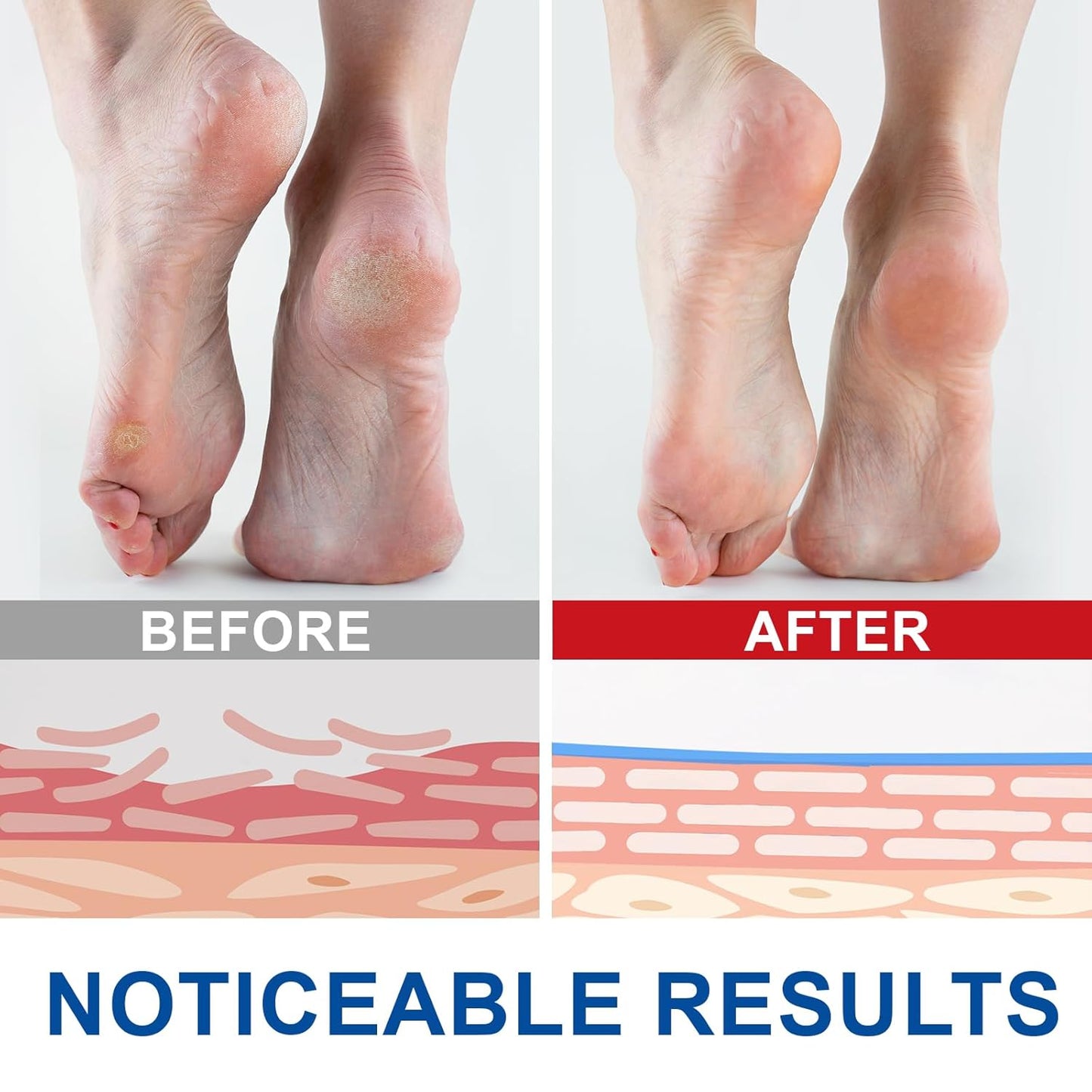 Urea Cream Stick 60% plus 2% Salicylic Acid for Feet Maximum Strength, Foot Lotion Stick for Rough Thick Dry & Cracked Skin, with Coconut Oil, Green Tea Extract, Tea Tree and Aloe Vera