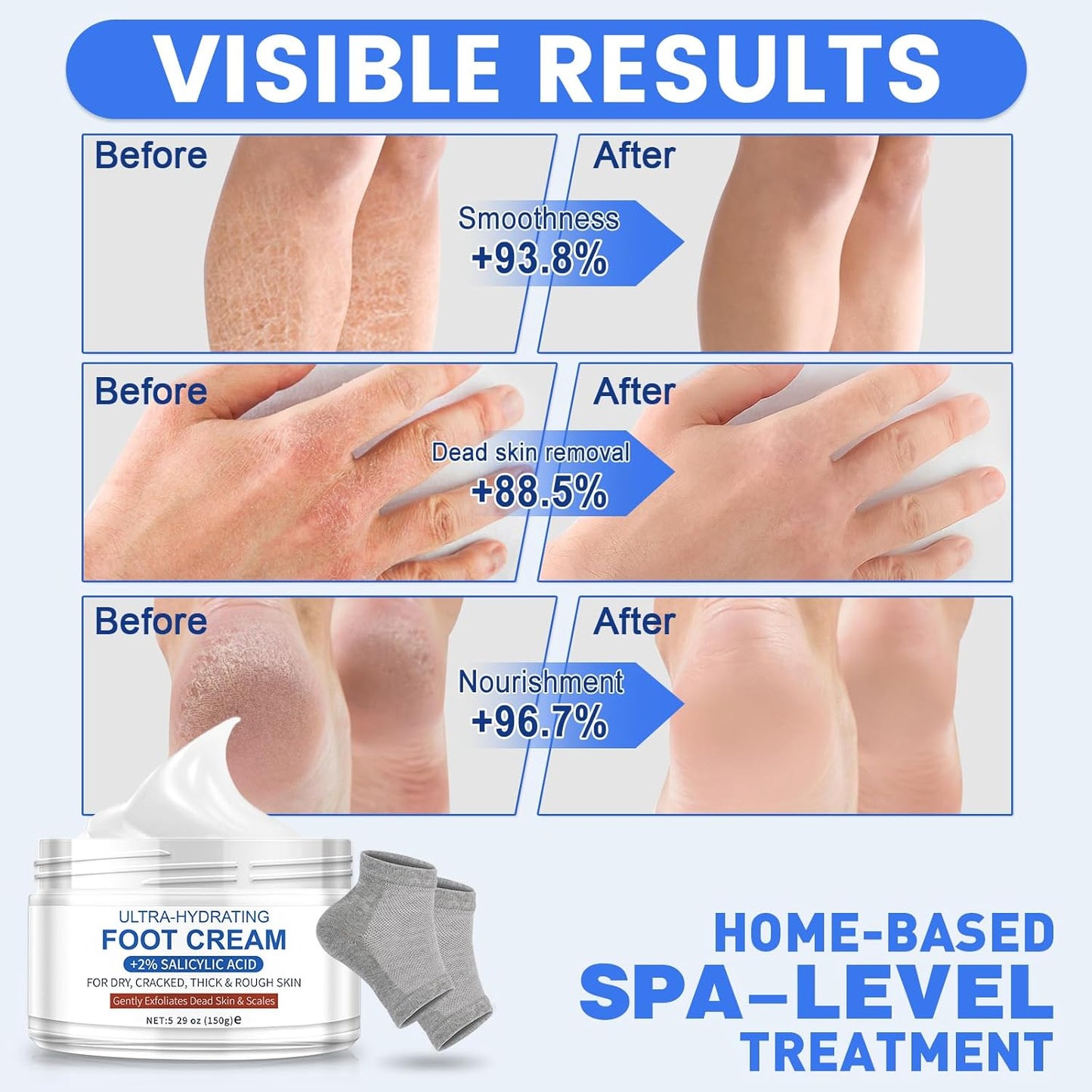 Ultra-Hydrating Urea Cream (Urea Conc. 40.67%), Foot Cream for Dry Cracked Heels and Feet, Pair with Moisturizing Heel Socks for Cracked Heel Treatment, Heel Socks Included (5.29 OZ/150g)