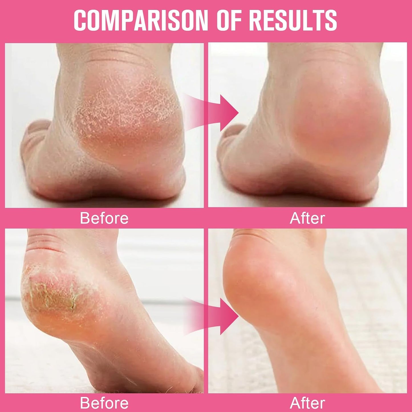 2PCS 60% Urea Hydrating and Anti-Cracking Foot Cream，2025 Upgraded Hand and Foot Cream Urea Moisturizer，Hydrates Dry and Cracked Feet and Hand (1.41 Ounce, Peach)